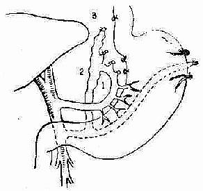 贲门周围血管离断术:即脾切除,同时彻底结扎,切断胃冠状静脉,包括高位