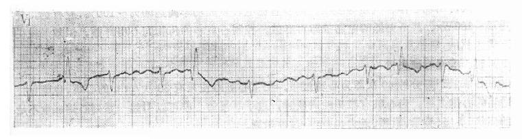 心房纤颤时差异传导的QRS波群