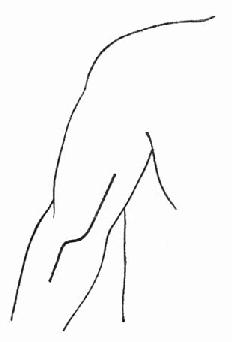 上肢动脉取栓于肘窝部作纵S形切口