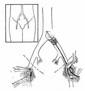 腹主动脉骑跨栓塞自左股总动脉取栓