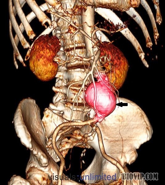 位于肾动脉和髂总动脉间的腹主动脉瘤（箭头）