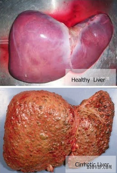正常肝脏 VS 肝硬化